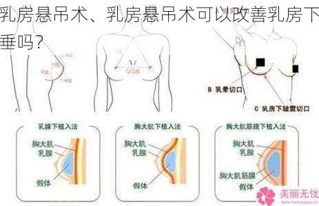 乳房悬吊术、乳房悬吊术可以改善乳房下垂吗？